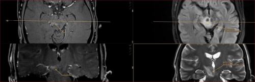Encephalitis, atypische virale HSV 1 Encephalitis mesencephal nach korrekter Diagnose und Therapie vollständige Genesung des schweren Krankheitsbildes
