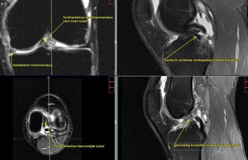 Korbhenkelriss des Innenmeniskus und vordere Kreuzbandruptur traumatisch