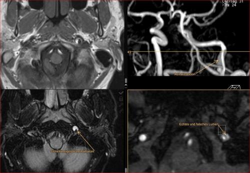 ACI-Dissection Schädelbasis klinisch Horner-Syndrom. Junger Mann der sein Kind "hochgeworfen" hat