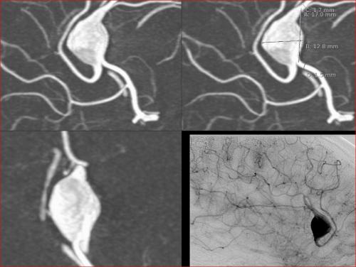 Komplexes pericallosa Aneurysma A2 Segment bei dem aus dem Dom die Gefäßachse weiterführt, die DSA Daten bestätigen auch, dass die callosmarginalis aus dem Aneuryma hervorgeht.Interventionell wurde eine FD „flow diverter" in einem spez. Zentrum eingesetzt