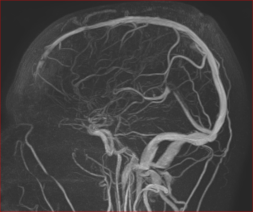 Sinös-venöse-Angiographie ohne Kontrastmittel mit dem neuen MRT zuvor oft Kontrastmittel notwendig