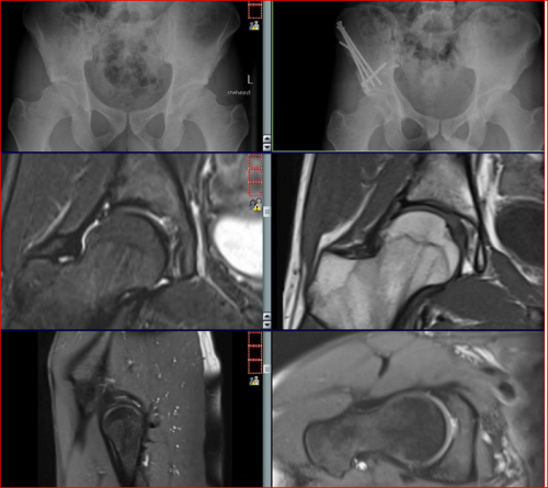 Junger Sportler (unter 25) Hüftdysplasie und femoroacetabuläres Impingement (eher seltene Kombination) Hüftchirurgisches Zentrum das wir sehr schätzen, Hüftgelenksarthroskopie für das (FAI) und PAO Umstellung des Beckens bei unzureichender Überdachung rechts