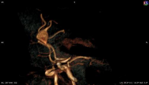 Komplexes Art. pericallosa Aneurysma A2 Segement im MRT bei aus dem Dom die Gefäßachse weiterläuft vor Intervention. DSA Daten siehe weiteres Bild