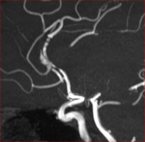 Komplex. A. pericallosa Aneurysma nach Intervention (extern) mit einem "mini flow diverter". Das Aneurysma ist ausgeschaltet, die A. cerbri ant. Achse und die A. callosomarginalis werden weiter durchströmt. MRT Angio Daten (slap-MIP Darstellung)