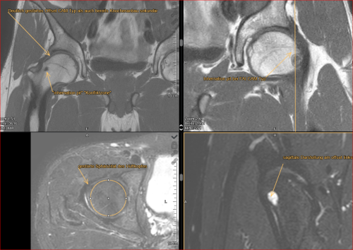 Junger Läufer: femoroacetabuläres - Impingement (FAI) CAM-Typ gestörtes Offset bds. Gefahr eine frühen Arthrose, hilfreich kann eine Korrektur des Offsets durch Hüftarthroskopie sein