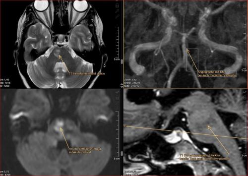 Pontiner-Hirnstamm-Infarkt-frisch-rechts paramedian Die Patientin wurde 3 Tage vor dem MRT hier aus einer Berliner Grossklinik mit "Stroke unit" und "Rettungsstelle" mit zu dem Zeitpunkt bestehender klarer Hirnstammsymptomatik ohne MRT Diagnostik entlassen aus der Rettungsstelle