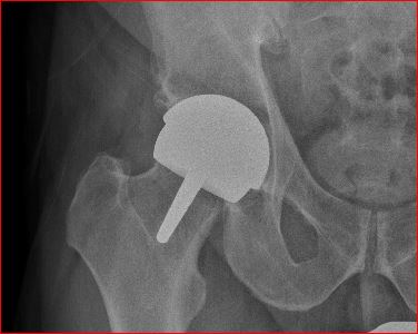 Hip Resurfacing, jeder mit einer "kaputten" (nicht zu rettende Hüfte und der vor der Entscheidung zur Prothese steht sollte sich über resurfacing informieren (hervorrragende Technik leider politisch (MoM) in Deutschland unter die Räder gekommen). https://grossortho.com/implant-update (sehr guter Wissensstand verständlich) https://surfacehippy.info (OP ABER NUR in Top Zentrum durchführen lassen! (wie folgend https://ancaclinic.com (Gefahr sonst Ergebnis schlechter als Standard Prothese)