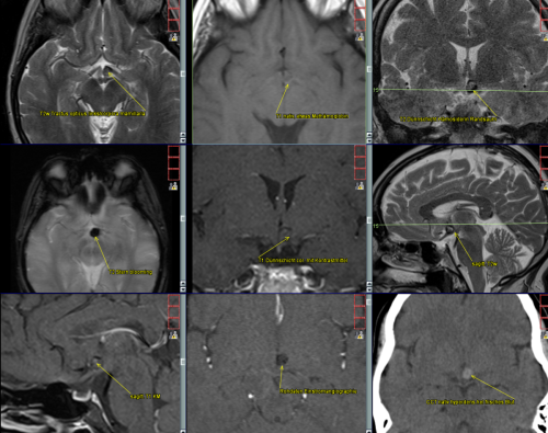 Rarität "Cavernous malformations of the optic pathway and hypothalamus" exophytisch bis extraaxial gelegen mit rel. frischer kleiner Einblutung. Klinisch nur kurz Kopfschmerzen. Vorstelllung in einem neurochirurgischen Zentrum mit hoher Expertise. DD Choristoma, hypothalamische Hamartie, Abrikossoff Tumor unwahrscheinlich. Gefahr der Visusbeeinträchtigung bei erneuter Enblutung des Cavernomes