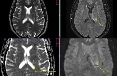 2 Innere Hirnvenenthrombose Stauungsödeme und Minderversorgung (Diffussionversminderung) Thalamus links
