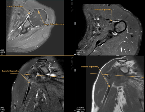 Schulter: Bicepssehne luxiert aus dem Sulcus bicipitalis (Verletzung des m.subscapularis und des "pulley" Mechanismus)