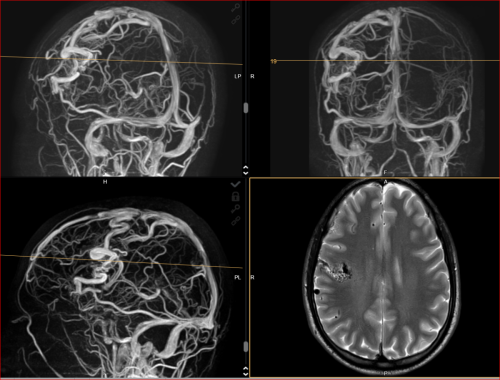 Piales-AV-Angiom-venös-sinöse Drainage