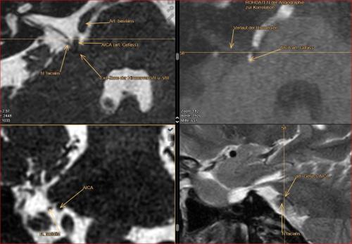 Hemispasmus facialis Beispiel für einen neurovaskulären-Konflikt Kontakt des Nervus facialis in der Exit Zone am Hirnstamm mit einem art. Gefäss hier AICA Folge: einseitige tonisch-klonische Kontraktionen der Gesichtsmuskulatur rechts.
