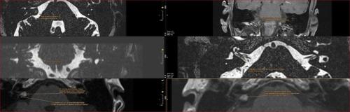 Kleinhirnbrückenwinkel: es ist nicht immer ein Meningeom oder Vestibularsischwannom Hyperostose des Meatus acusticus internus rechts diese wurde jahrelang und wiederholt extern als Vestibularischwannom "diagnostiziert" beschrieben