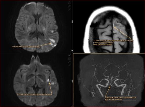 Frische-(und-ältere) Ischämien Infarkte (im externen) CT Fehleinordnung Stationärer (!) Patientin einer Berliner Grossklinik mit Neurologie die 3 Tage vorher mit akuter Sprachstörung im CT irrtümlich als Metastasen eingeordnet. Ambulante Untersuchung im MRT bei uns durch die Kinder initialisiert.