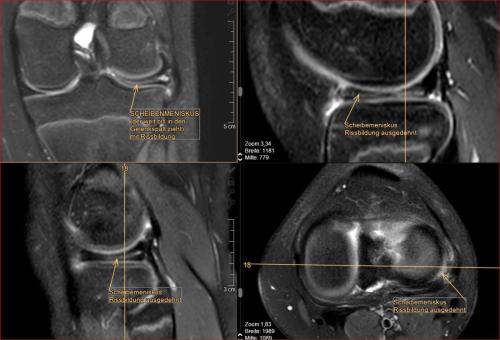 Scheibenmeniskus, deutliche Rissbildung des Außenminiskus bereits im 12 Lebensjahr Operative Theapie bereits in dem Alter notwendig.