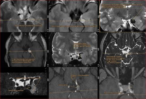 Dermoid cavernosal - Ausdehung temporomesial links mit komplex fokaler Epilepsie (sehr sehr selten Dermoid überhaupt und in dieser Lokalisation, mit der Auswirkung komplex. focal Anfälle nach unserer bisherigen Kenntnis nicht beschrieben in der Literatur