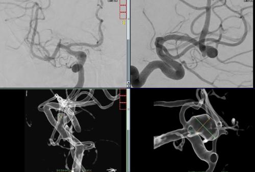 Aneurysma re. 7 mm Darstellung in einer DSA (digitalen Subtraktionsangiographie)  links nur ein 2 mm "Baby-Aneurysma"  Im MRT war zuvor das linke Aneurysma aufgefallen, die Auflösung einer DSA ist technisch im MRT nicht erzielbar, beide A. liegen in der ACM Bifurkation jeweils, das re. Aneurysma wurde erfolgreich operiert, das linke Aneurysma wird kontrolliert.