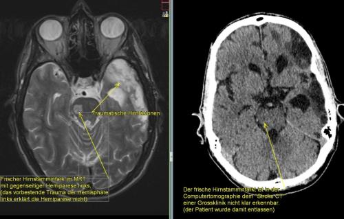 Stroke - Grenzen der Computertomographie Vergleich MRT