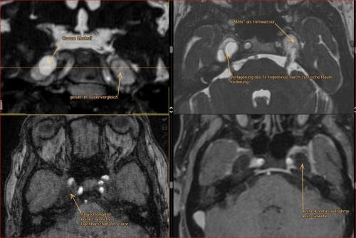 Meckeli-cavum Dilatation bds. bei trigeminus Neuralgie links extrem selten wahrscheinlich Cephalalocele und zu einem Syndrom assoziiert, beachte Gewebeplus links