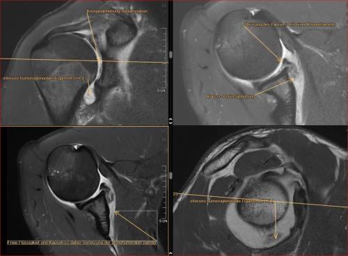 GLAD- Läsion Schulter nach Anpralltrauma, Ablösung von Labrum und Knorpel ventral cranio-caudal ausgedehnt traumatisch. Dabei auch Verletzung der glenohumeralen Bänder (IGHL) daher ggf. Instabilität. Falls Kapsel- Bänderrisss ausgedehnt Bankart Läsion