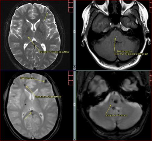 Cavernome multiple familiär (autosomal dominant vererbt) im Verlauf über Jahre immer wieder kleinere Einblutungen der multiplen Cavernome und Schwankungen dieser, sehr seltene Erkrankung, reiner Zufallsbefund nach Verkehrsunfall (ohne Koma) und daher keine traumatische Genese Diffuse axonal injury (DAI)