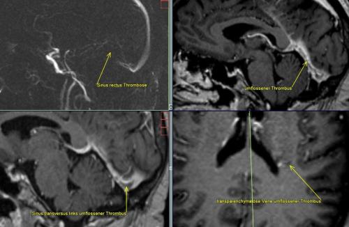 1 Innere Sinusvenenthrombose sinus rectus thrombosiert