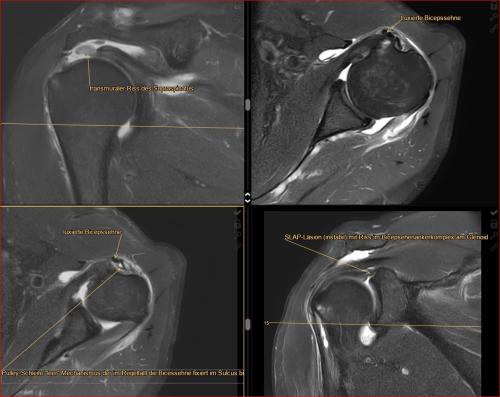 Schulter-SLAP-Läsion instabil_  Pulley-Verletzung mit luxierter Bicespsehne_  Riß-transmural des M. supraspinatus