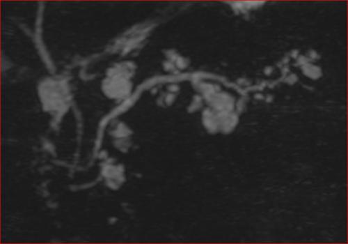 IPMN = Intraduktale papilläre muzinöse Neoplasie multiple gemischter Typ überwiegend Seitenasttyp multipel in einer MRCP Darstellung des Pancreas