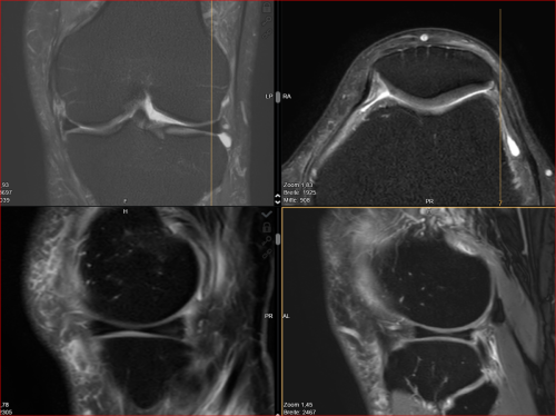 70 jähriger Läufer Marathon bis Ultrastrecke alle Kompartimente noch schön und gut erhalten -nach über 50 Jahren laufen! Bemerkenswert und unerwartet (MRT nur bei aktuellem Trauma)